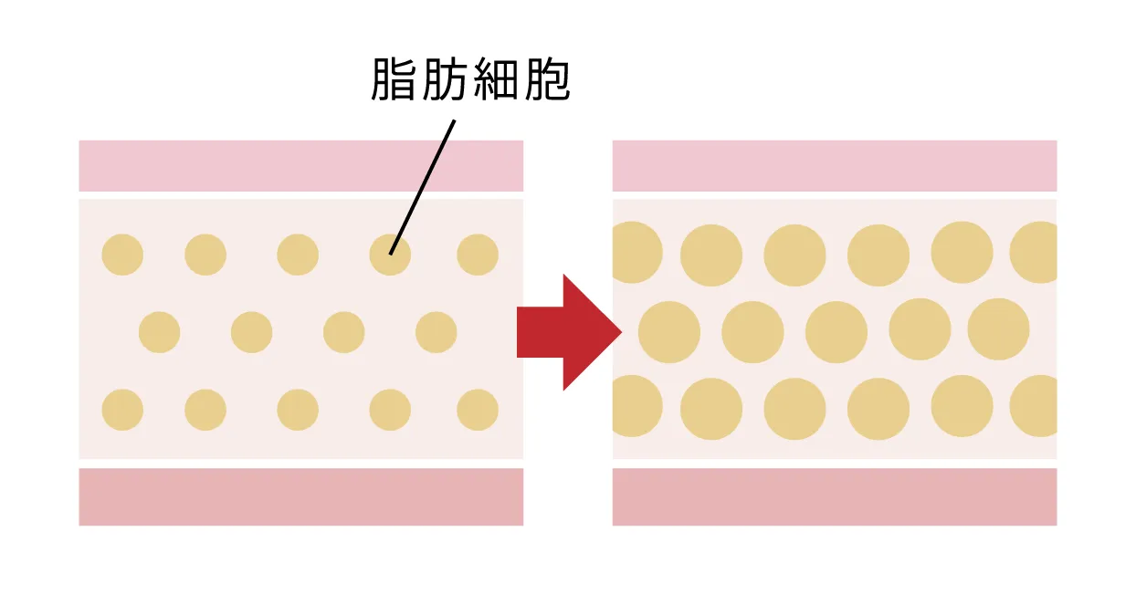脂肪増殖のイメージ